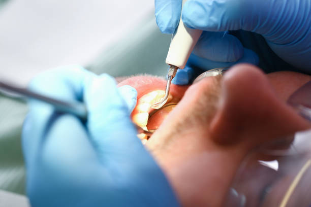Best Emergency Tooth Extraction in Waterville, OH